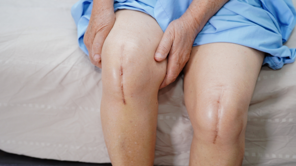 Joint Replacement Surgery