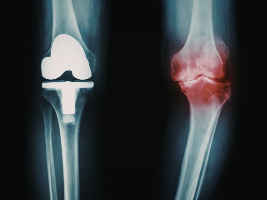 Robotic Joint Replacement